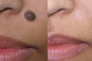 Cuticare skin & cosmetology Centre in trichy,best quality yet affordable skin & cosmetology services to everyone